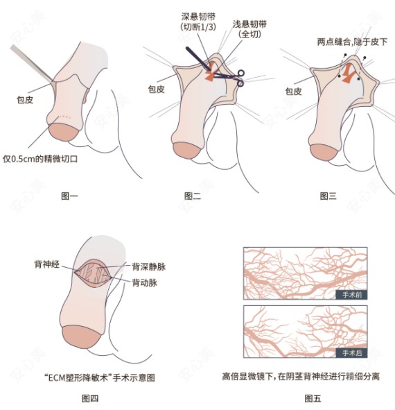 李世荣的延长增粗术到底强在哪？