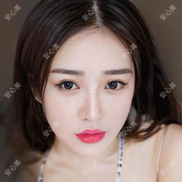 兰州市爱美尔整形靠谱吗？双眼皮8800元起，玻尿酸填充1980元/支