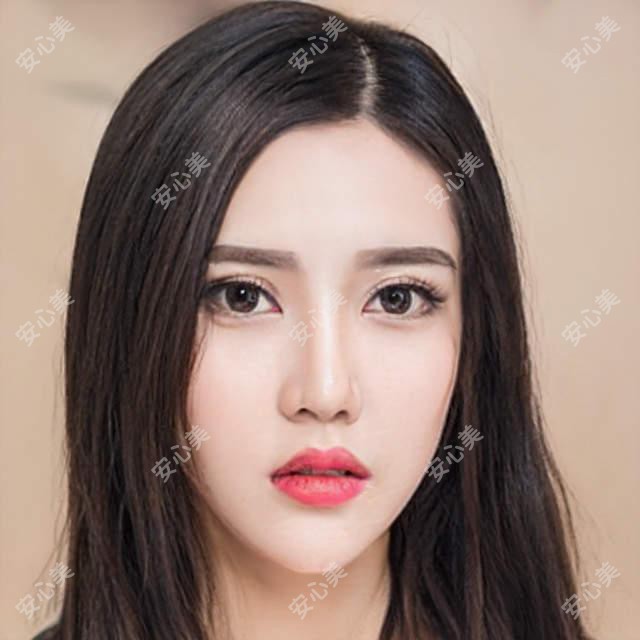 南阳尖峰眼科程正福医生全飞秒手术测评：ICL晶体植入稳准安稳，高度近视矫正疗效自然恢复较快