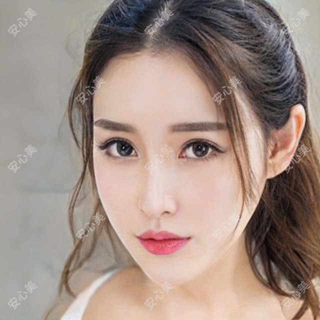 大理市眼周填充项目体验分享:3k起改善凹陷+年轻感明显,但维持期6个月左右