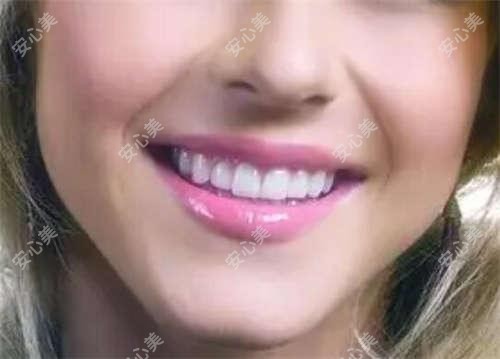 桂林任文明医生5F美雕术解析:叶氏嘉美双眼皮与抗衰微整形医生