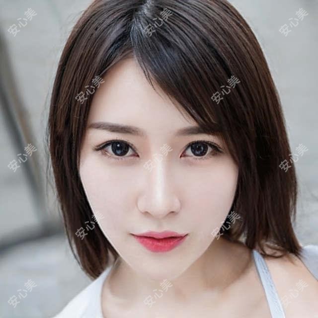 青岛注射隆鼻|3D微雕鼻部塑形6800起 自然立体疗效太惊艳了!