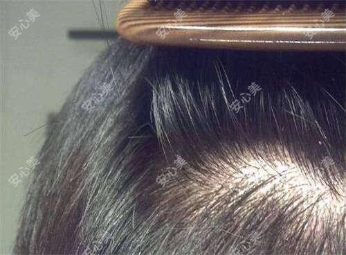 遵义做FUE3.0植发技术多少钱?抓紧看头发植发和秃顶植发价格表