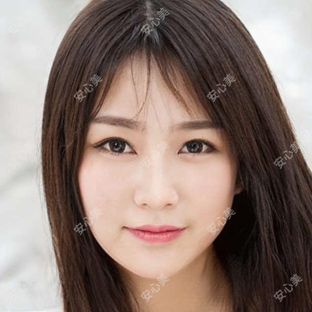 张传青整形医生-潍坊华美张传青医生埋线提升双眼皮自然分层抗衰