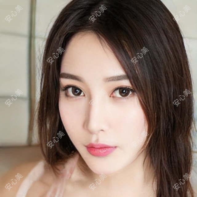 北京直角肩玻尿酸需要几支 价格与疗效全解析