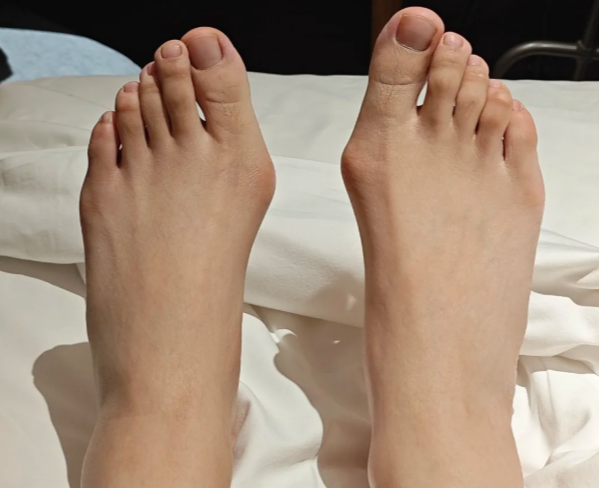 李昕宇拇外翻手术预约方式