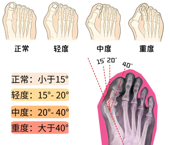 为什么大家愿意找李昕宇做拇外翻手术?