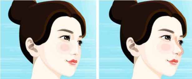 衡阳雅美廖伟龙做鼻子的真实实例