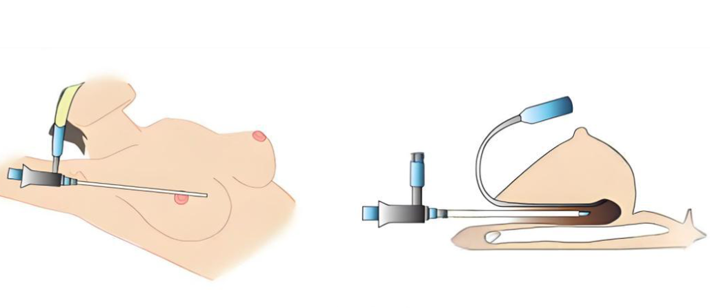 杭州胸部异物取出医院排名新版出炉