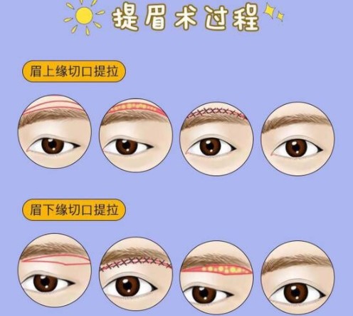 苏州不手术去眼袋技术对比