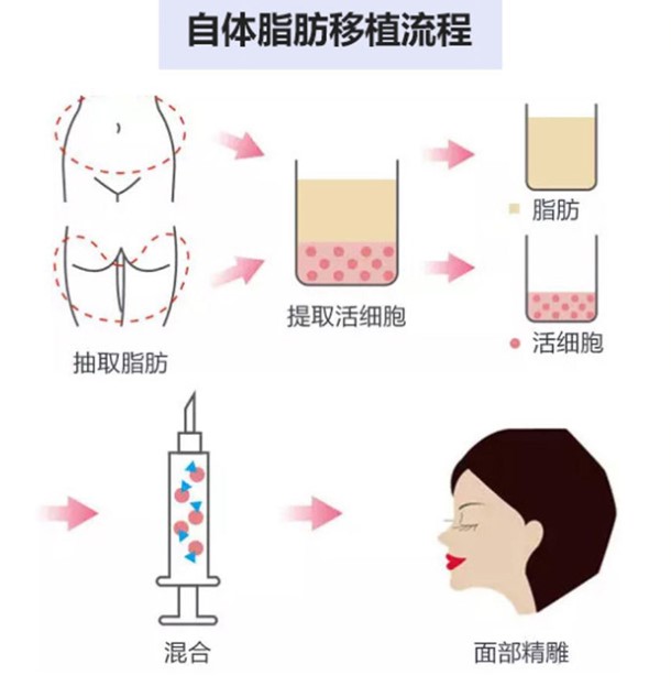 郑州杨柳医生抽脂过程