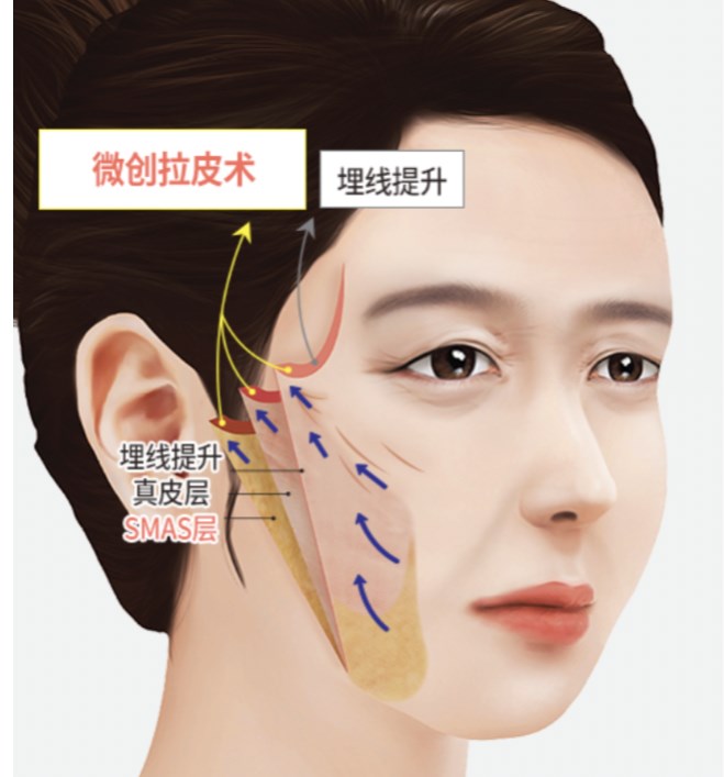 郑州哪家整形医院做筋膜提升做的好