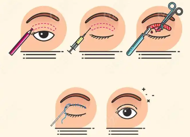 呼和浩特孔怀川修复双眼皮失败实例