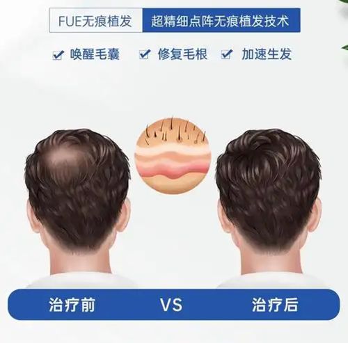 植发3500个毛囊需多少费用