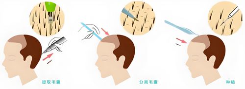 植发3500个毛囊价格