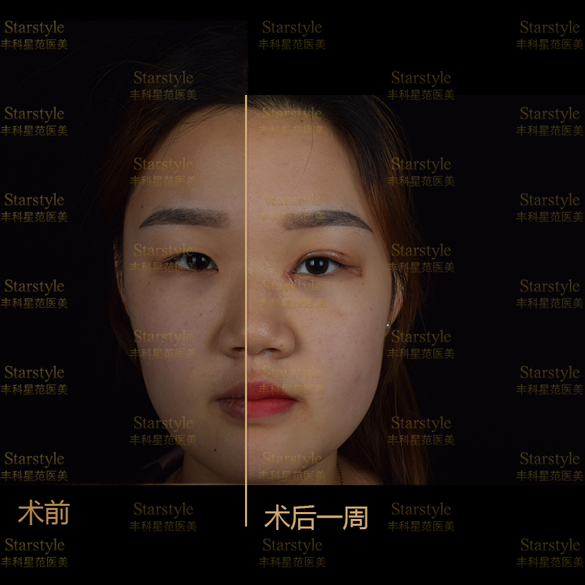 三、整形医生粟娜肿眼泡修复专项方案与价格参考www.axfork.com