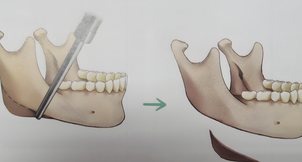 三、选择磨骨医生的关键指标