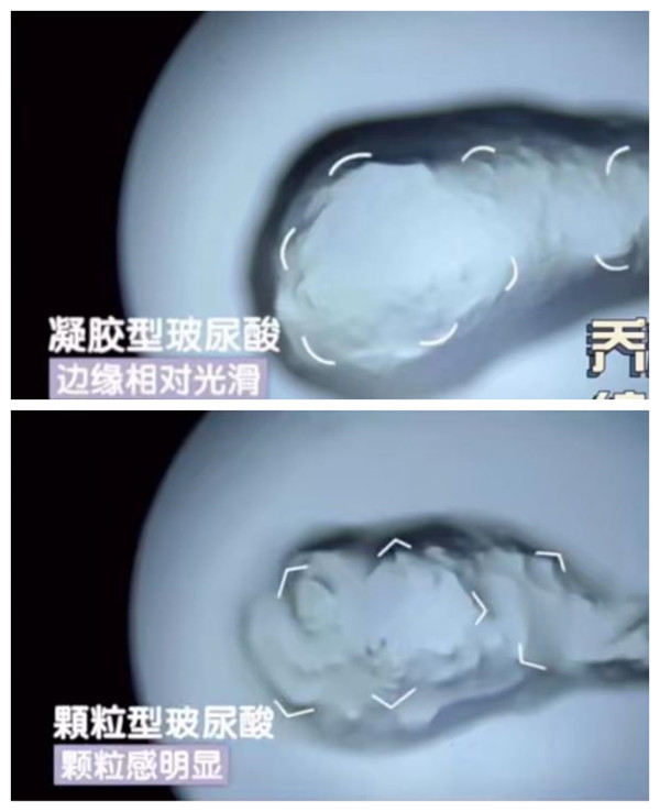 五、宜兴玻尿酸预约&到院攻略:少跑冤枉路