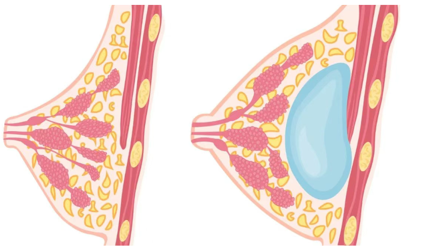 五、曼托和妙桃的术后疗效与特点有何不同表现？