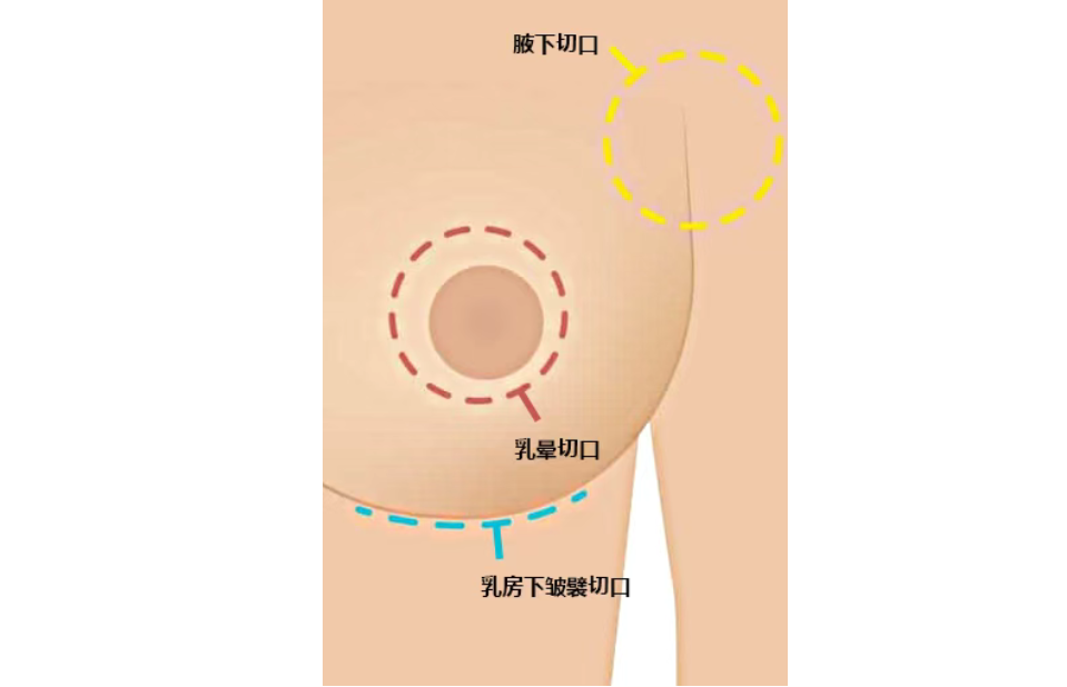 八、使用曼托和妙桃假体有哪些注意事项？